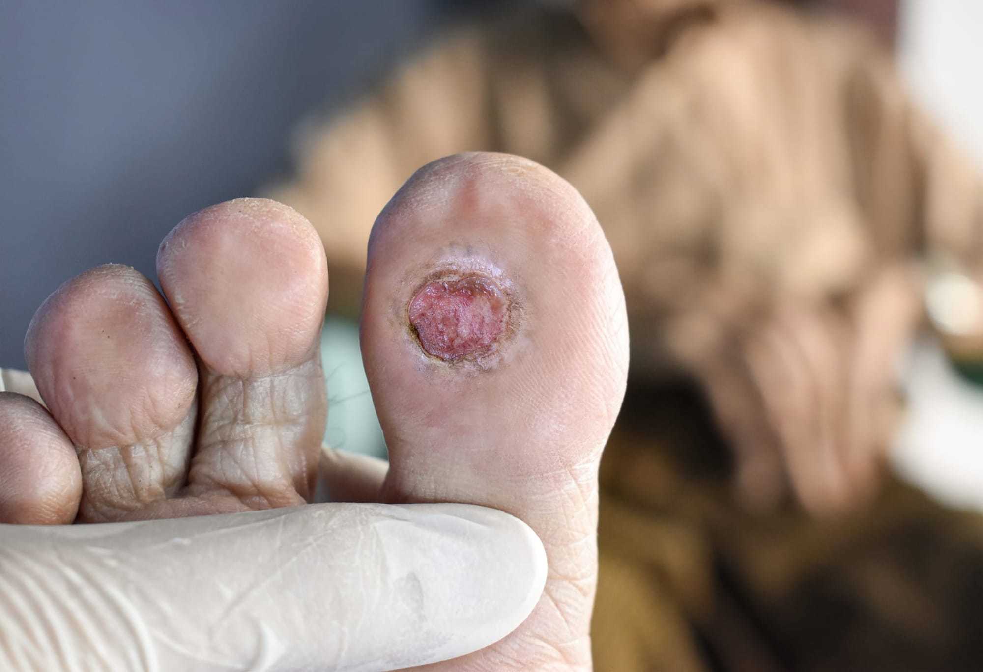 foot ulcer on bottom of toe